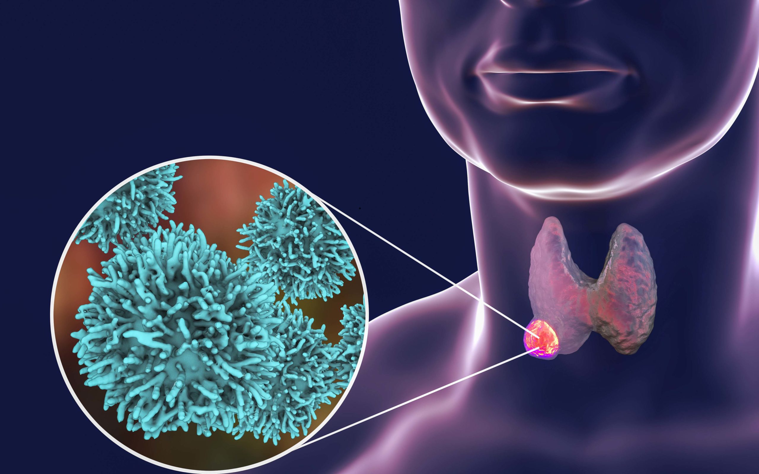 Thyroid cancer. 3D illustration showing thyroid gland with tumor inside human body and closeup view of thyroid cancer cells