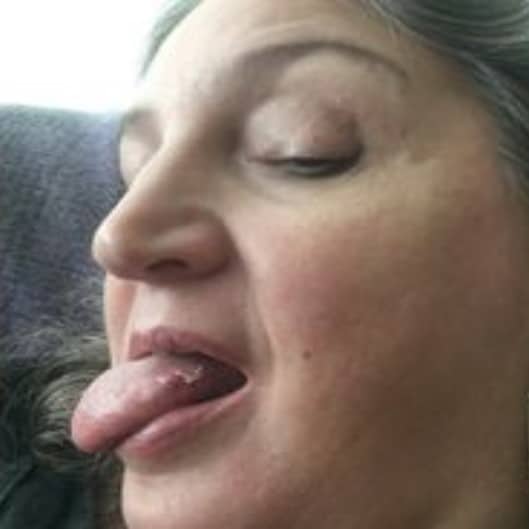 First sign of tongue cancer